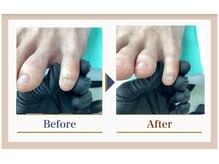 巻き爪補正店 錦糸町店/【副爪ケア】
