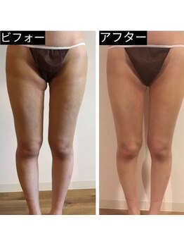 スリーピングビューティー(Sleeping Beauty)/インディバ　術後ケア