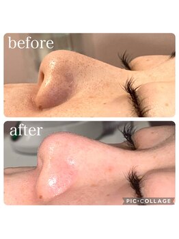 リフュージュ(refuge)/ハイドラ毛穴洗浄◎