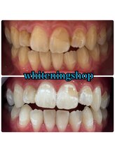 ホワイトニングショップ 越谷せんげん台店/Before After美白ホワイトニング