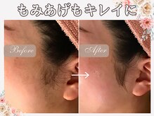 マリスステラ 天王寺(MarisStella)/顔シェービングで横顔美人♪