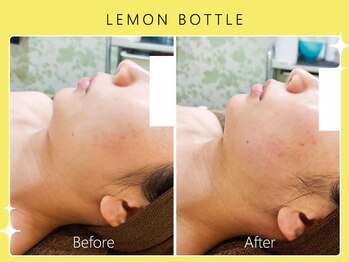 ハノハノ 八代店(HANO HANO)/【八代初導入!】レモンボトル☆