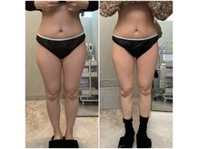 ジュエル(JEWELL)の雰囲気（【脂肪冷却モニター様】すっきり洗練された美脚ラインへ）