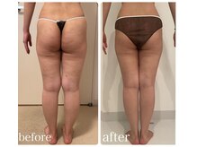 美人バスト 新宿店/☆姉妹店ダイエット症例写真☆