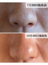 エン(EN。)/施術症例【毛穴】