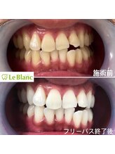 ルブラン 奈良店(Le Blanc)/歯にダメージを与えない！