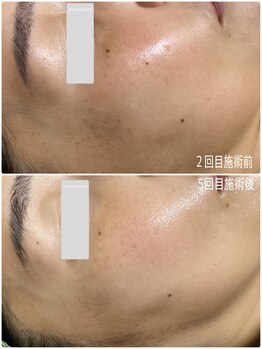 ブライトリー(Brightly)/シミ改善途中経過です!