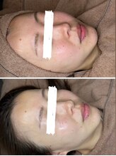 ヌン(NUN.)/ララピール