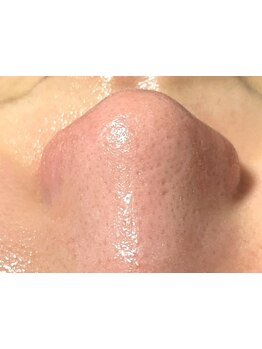 メンズフェイシャル