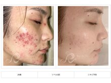 エイミー 名古屋駅前店(eimy.)/ハーブピーリング/名古屋