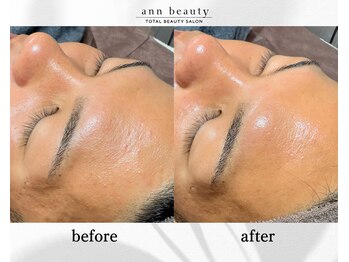 アン ビューティー(ann beauty)/施術1回【症例写真】