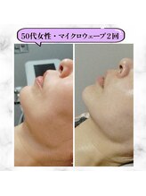 グランディールアン(GRANDIR UN)/マイクロウェーブリフト2回目