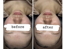 ビズエー(viz.A)/ワックス＋ハーブピーリング 