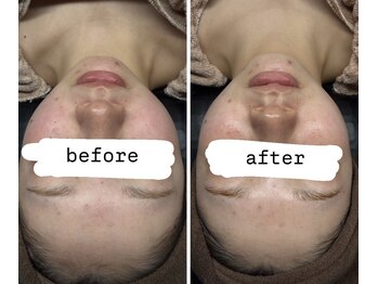 ビズエー(viz.A)/ワックス+ハーブピーリング