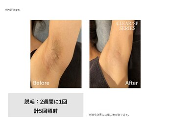 ドルチェビューティーサロン 戸塚安行店(Dolce Beauty Salon)/脱毛（ワキ）_施術5回