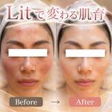 【毛穴洗浄/肌質改善/ピーリング/フェイシャル】 &nbsp;SOW