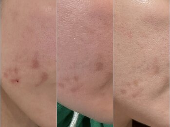 エマ(emma)/KMP韓国式ハーブピーリング