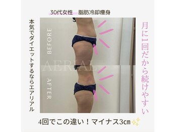 エアリアル 武雄店/脂肪冷却痩身ビフォーアフター