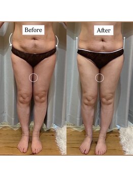 ミルティー(Myrtille)/50代1ヶ月施術後