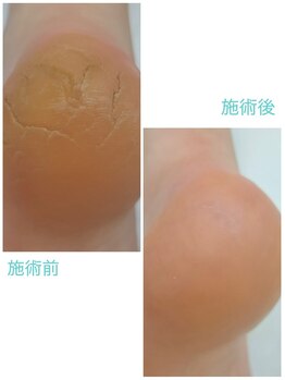 レフス 北参道店(REFUSS)/本格角質ケア