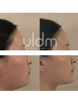 ラヴィ(Ravi)/コラーゲンフィラーUldm