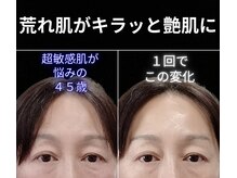 目元 口元のたるみ 眉間シワ改善専門サロン/ずっと荒れ肌が改善しない方向け