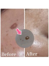 ルタンリッシュ ハナレ(Lutan Riche 花麗)/ぺろんと剥がれる最新シミケア！