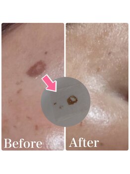 ルタンリッシュ ハナレ(Lutan Riche 花麗)/ぺろんと剥がれる最新シミケア!