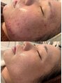 毛穴ラボ 渋谷(毛穴LABO)&nbsp;【ハーブピーリング/毛穴/ニキビ/シミ/AI肌診断機/肌診断】