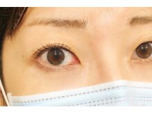 ルピナス(Lupinus)/アミノ酸ラッシュリフト