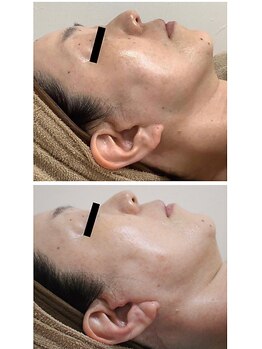 カブール 町田/真っ白に変わった肌質