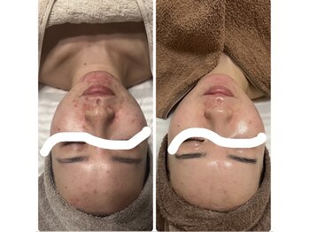 ジェニー(JENNI)/ハーブピーリング