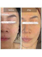 ラビ(RABBI)/40代女性小顔矯正プラチナリフト