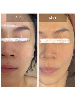 ラビ(RABBI)/40代女性小顔矯正プラチナリフト