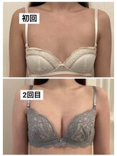 美人バスト 町田店/バストアップ◇症例◇