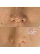 サロン ウーカ(salon WOOCA)/セラピール【毛穴/ニキビ/シミ】