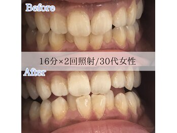 ホワイトニングカフェ 藤が丘店(WhiteningCafe)/2回分照射☆