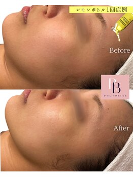 フォトビズ/二重あごもたつきたるみ改善