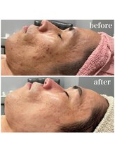 ジョアアンジェ 京橋店(joie ange)/ニキビケアにはクリスティーナ