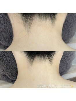 カルディエ(Cardie)/うなじ脱毛　ビフォーアフター
