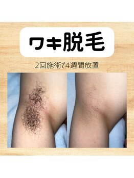 ビクト(Vict)/毛があるとニオイの元に、、?!