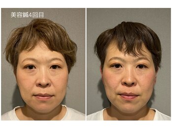 至福の空間 まごのて/【美容鍼4回目】ビフォアフター