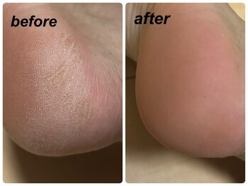 ネイルモア 藤が丘店(nail mor.)/フット角質ケア