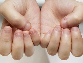 ミンスネイル(Mins Nail)の写真/深爪/噛み爪/剥き爪でお悩みの方 深爪ケアの施術経験豊富◎丁寧なケアにこだわり美しい手元を演出