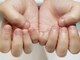 ミンスネイル(Mins Nail)の写真/深爪/噛み爪/剥き爪でお悩みの方 深爪ケアの施術経験豊富◎丁寧なケアにこだわり美しい手元を演出