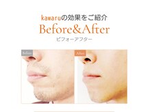 カワル(kawaru)の雰囲気（ヒゲ脱毛も１回でもポロポロ抜ける！と感動♪VIO/全身脱毛も◎）