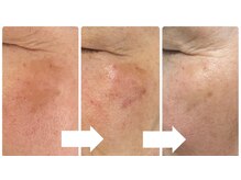 エム 佐賀江北店(EMU)/長年のシミは改善できる！