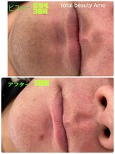 アモ(amo)/髭脱毛５回目ビフォーアフター