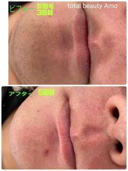 アモ(amo)/髭脱毛5回目ビフォーアフター