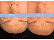 ステラ(STELLA)/縦横のシワアプローチ♪